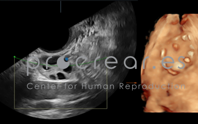 ¡PREVINIENDO LA INFERTILIDAD!